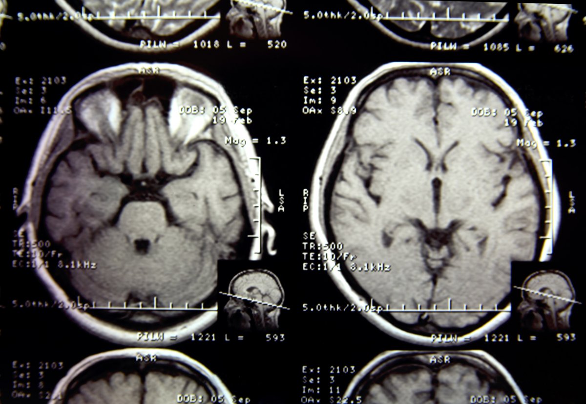 Long-Covid: La proteína se deposita en el cerebro como en el Alzheimer o el Parkinson