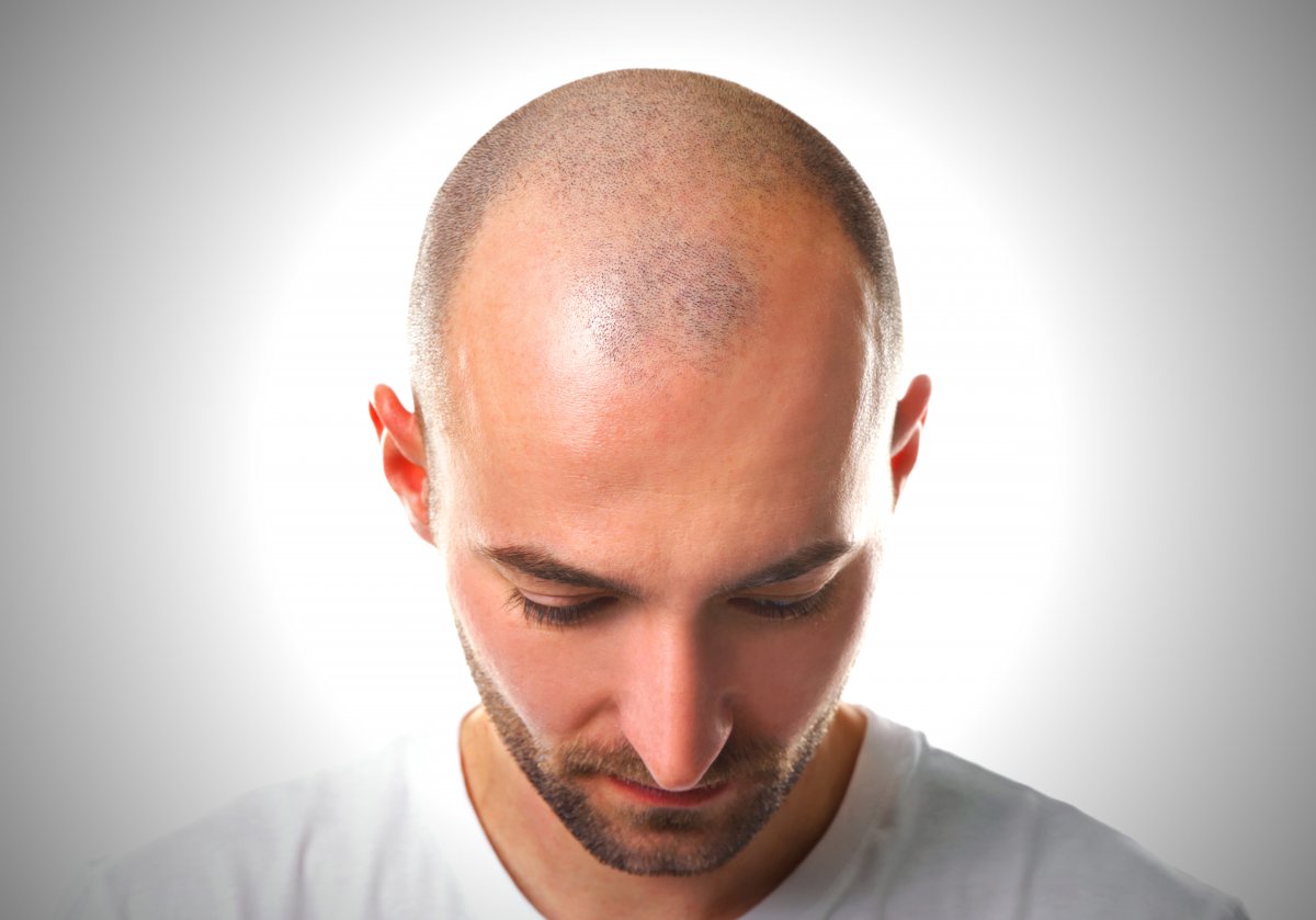 Steuerungsprotein für Haarverlust offenbar gefunden