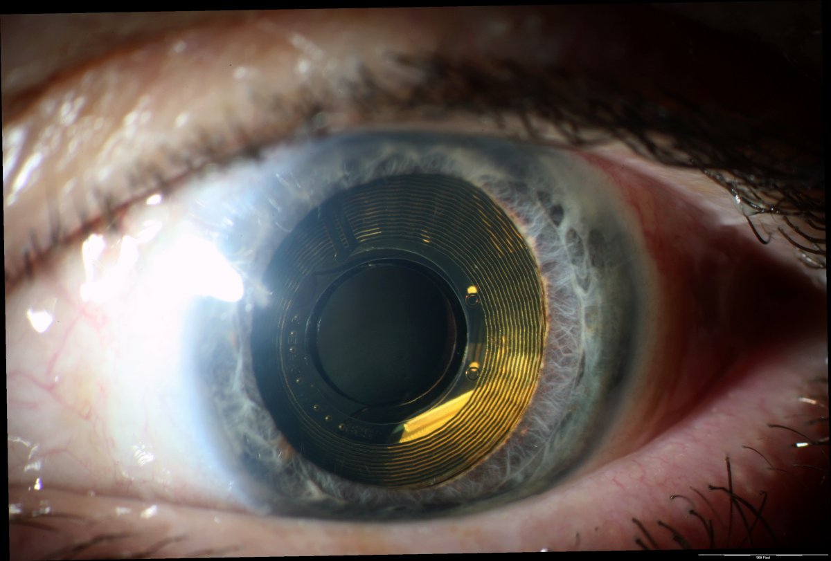 Retina-Implantate: Ohne Support erblinden Patienten wieder