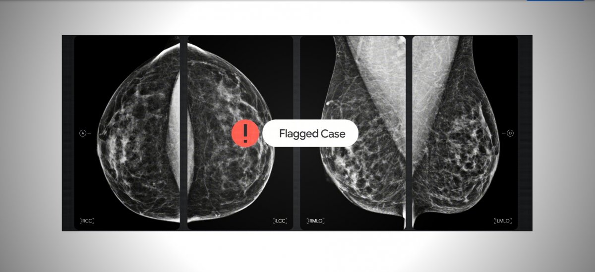 Brustkrebs-Screening mit KI: Google kooperiert mit Medizintechnik-Unternehmen