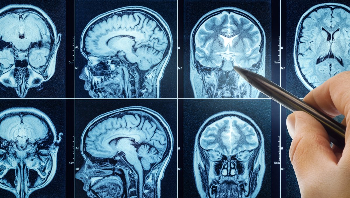 Researchers have detected microplastics in the human brain