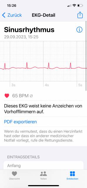 EKG in Apple Health