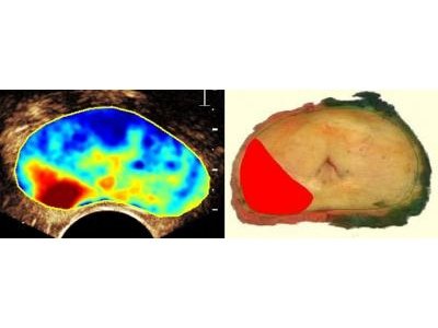 Prostata-Untersuchung mit dem &quot;Contrast Ultrasound Dispersion&quot;-Verfahren. Der Tumorbereich ist rot eingefärbt.