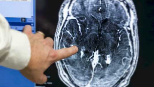 Ultraschall und Gasbläschen ermöglichen erstmals Öffnung der Blut-Hirn-Schranke