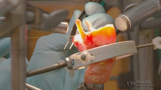 Künstliche Implantate sollen Kranken ihre Stimme zurückgeben