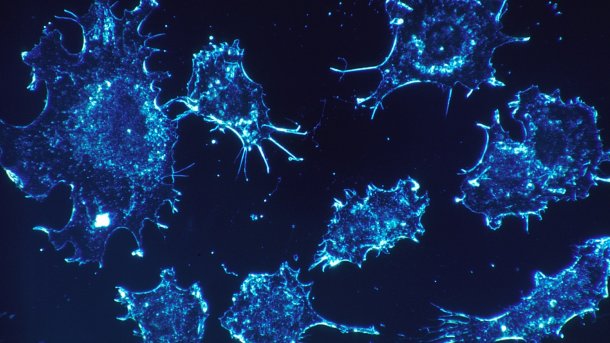 KI erkennt Krebszellen