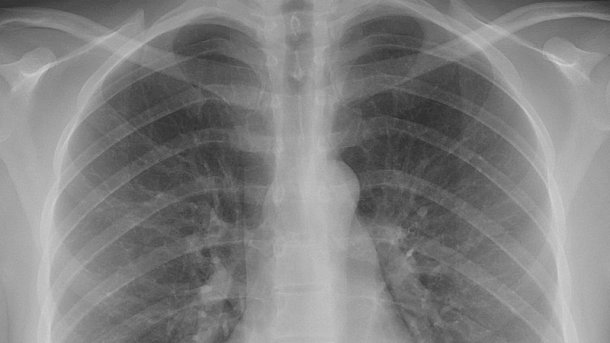 Google erkennt Lungenkrebs in CT-Aufnahmen