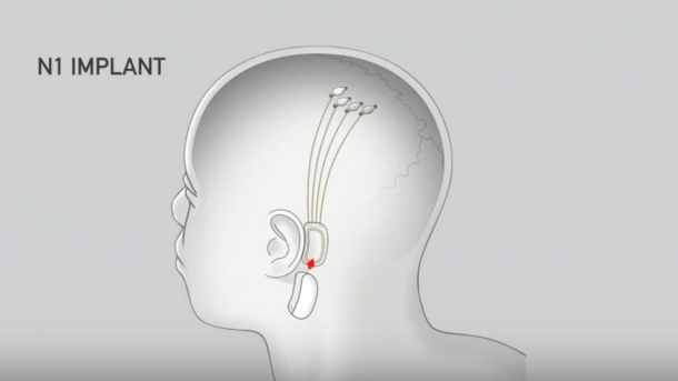 Neurologen an Elon Musk: Neuralinks Hirn-Implantat ist "unseriöser Hype"