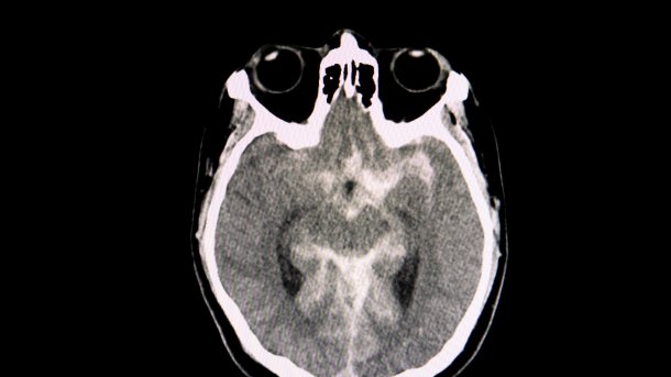 CT-Scan des Gehirns eines Patienten mit akuter Subarachnoidalblutung nach einem Verkehrsunfall