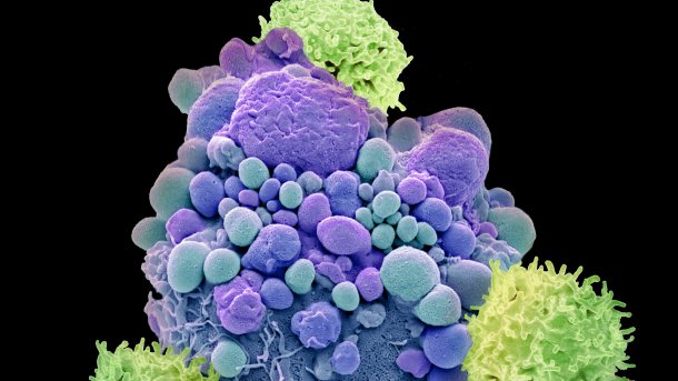 "Grüne" T-Zellen zerstören "blaue" Zellen eines  Gehirntumors. In der Realität ist der Kampf der Zellen weniger farbenfroh. Die Aufnahme stammt von einer Gewebeprobe im Elektronenmikroskop und wurde nachkoloriert. , Science Photo Library / Steve Gschmeissner 