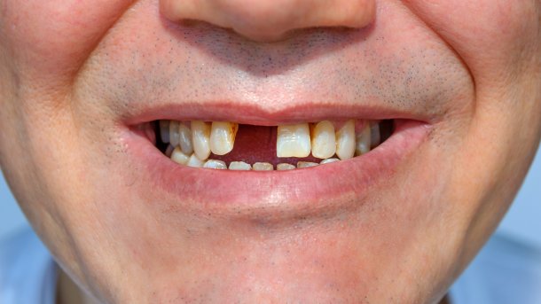Person mit Zahnlücke