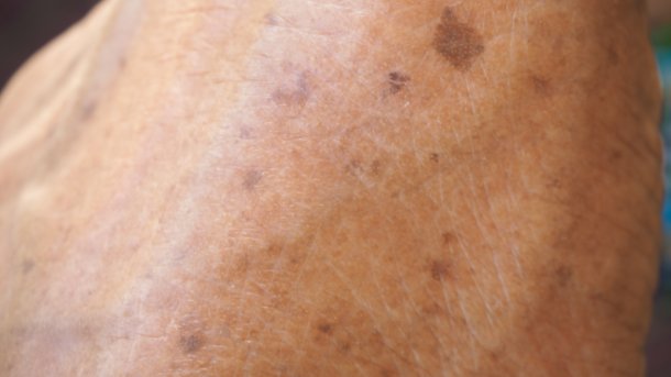 Melanom auf einer Hand