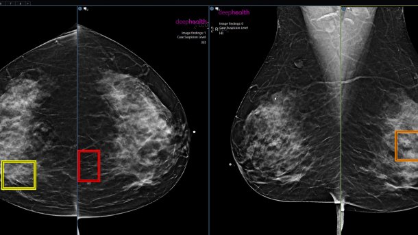 Beispiel für einen Verdachtsfall, der mit KI-Hilfe erkannt wurde