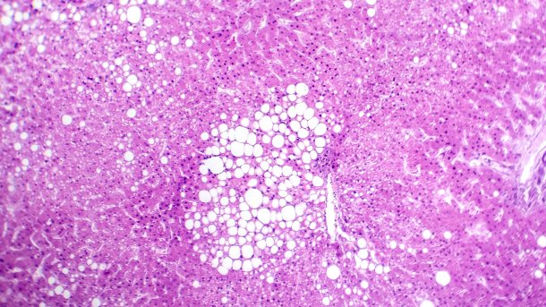Fotomikrograph der Hepatosteatose, der eine Fettansammlung in Leberzellen, bekannt als Fettlebererkrankung, aufzeigt.