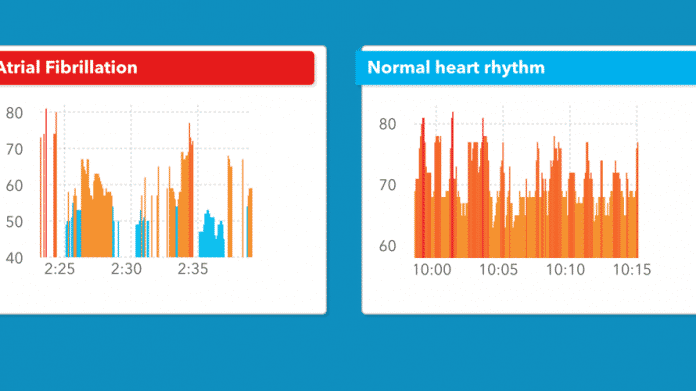 Studie: Apple Watch erkennt abnormalen Herzrhythmus