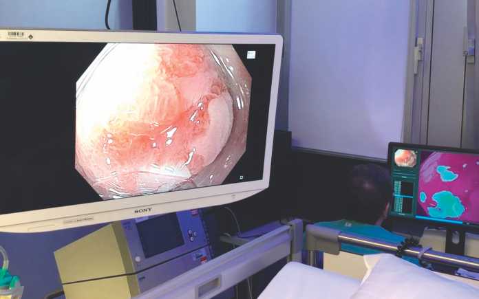Anhand hochauflösender Weißlichtaufnahmen hilft eine KI noch während der Endoskopie bei der Früherkennung von Krebs.