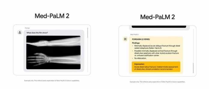 Beispielmaterial aus Googles Med-PaLM 2, einem noch nicht öffentlichen medizinischen großen Sprachmodell, das künftig auch Röntgenbilder auswerten können soll.
