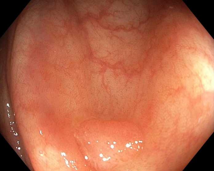 Small adenoma (bottom, center) which is removed as part of colorectal cancer screening.