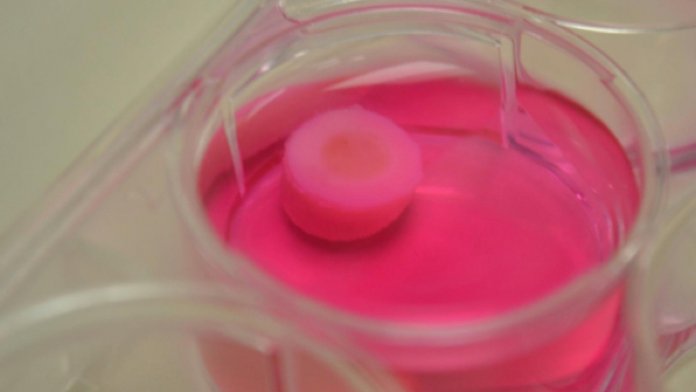 Mit dem 3D-Printer gegen Arthrose