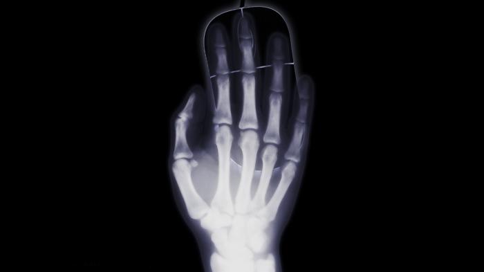 Röntgenbild einer rechten Hand auf einer Computermaus